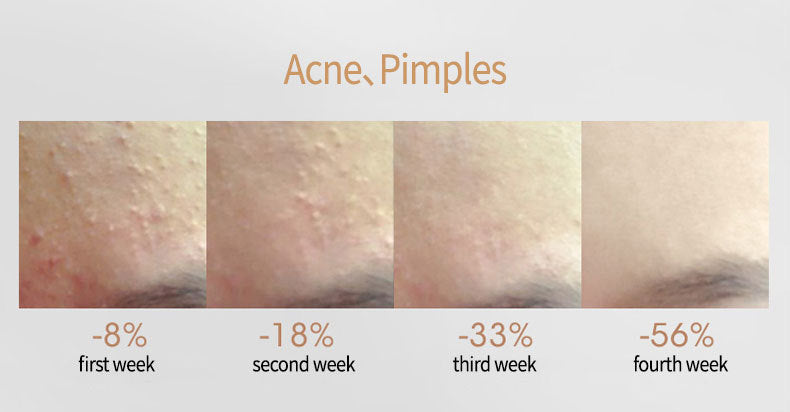 Ansiyi Acne Removing Salicylic  Acid Serum
